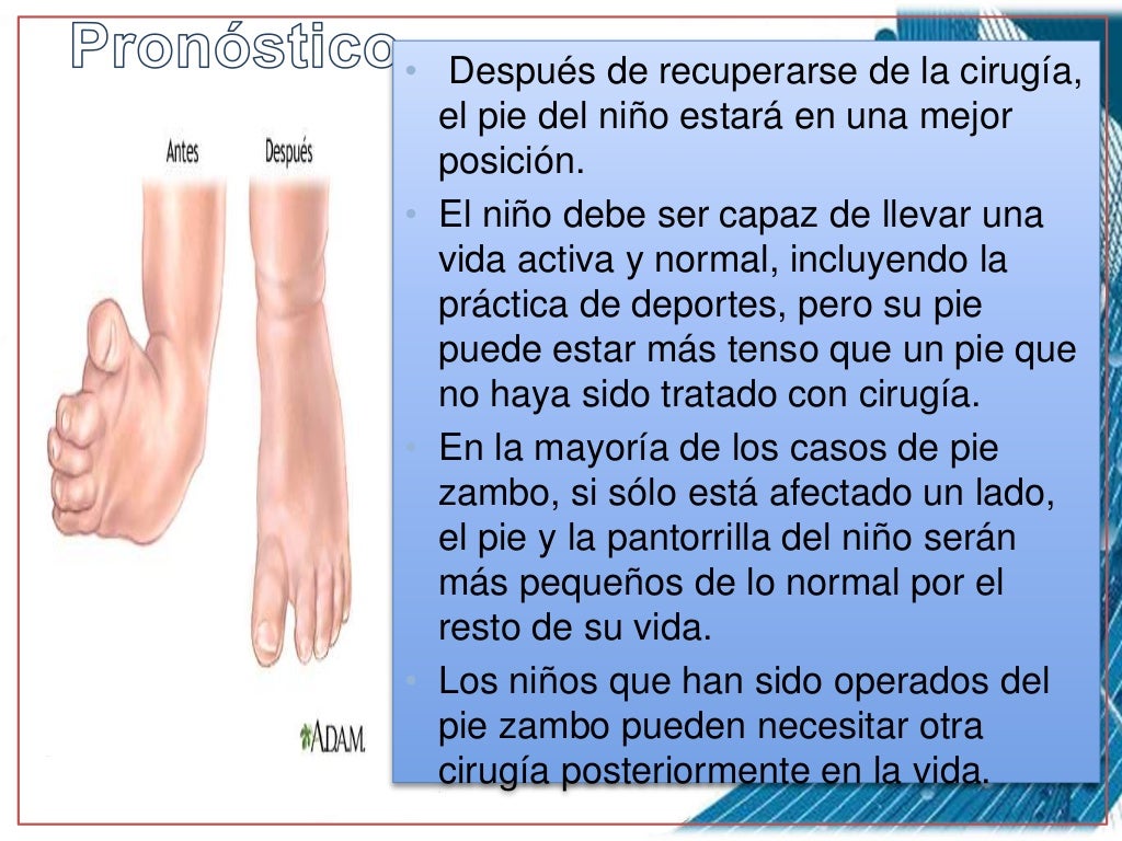 Pie equino varo charla