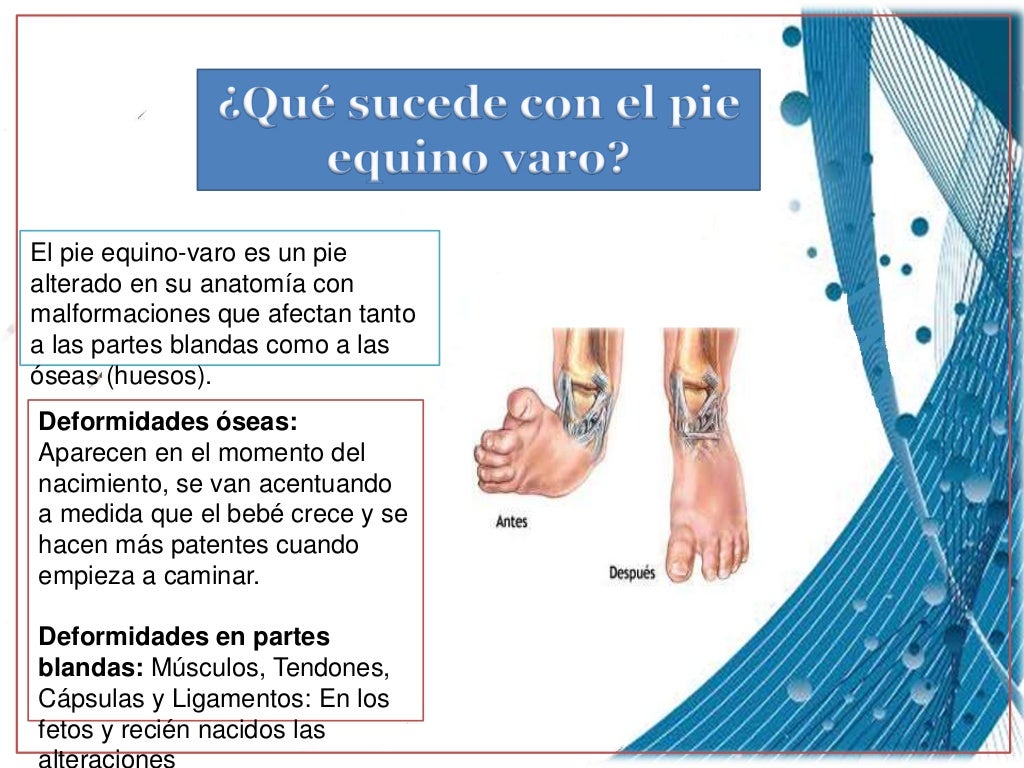 Pie equino varo charla