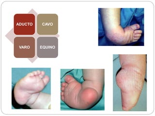 ADUCTO CAVO 
VARO EQUINO 
 