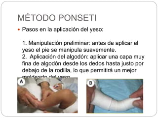 MÉTODO PONSETI 
 Pasos en la aplicación del yeso: 
1. Manipulación preliminar: antes de aplicar el 
yeso el pie se manipula suavemente. 
2. Aplicación del algodón: aplicar una capa muy 
fina de algodón desde los dedos hasta justo por 
debajo de la rodilla, lo que permitirá un mejor 
moldeado del yeso. 
 