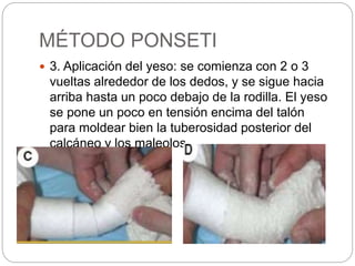 MÉTODO PONSETI 
 3. Aplicación del yeso: se comienza con 2 o 3 
vueltas alrededor de los dedos, y se sigue hacia 
arriba hasta un poco debajo de la rodilla. El yeso 
se pone un poco en tensión encima del talón 
para moldear bien la tuberosidad posterior del 
calcáneo y los maleolos. 
 
