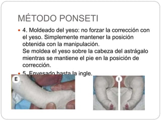 MÉTODO PONSETI 
 4. Moldeado del yeso: no forzar la corrección con 
el yeso. Simplemente mantener la posición 
obtenida con la manipulación. 
Se moldea el yeso sobre la cabeza del astrágalo 
mientras se mantiene el pie en la posición de 
corrección. 
 5. Enyesado hasta la ingle. 
 