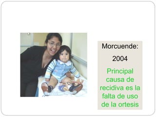 Morcuende: 
2004 
Principal 
causa de 
recidiva es la 
falta de uso 
de la ortesis 
 