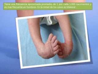 Tiene una frecuencia aproximada promedio de 1 por cada 1.000 nacimientos y
es mas frecuente en hombres. En la mitad de los casos es bilateral .
 