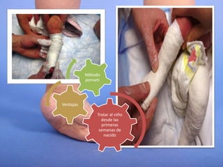 Tratar al niño
desde las
primeras
semanas de
nacido
Ventajas
Método
ponseti
 