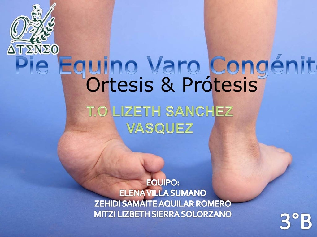 Pie equinovaro congénito