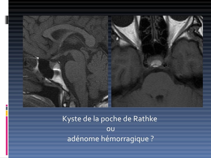 Kyste De La Poche De Rathke Opération
