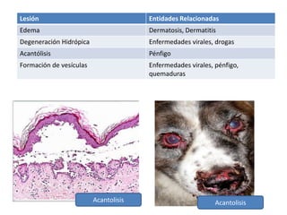 Lesión

Entidades Relacionadas

Edema

Dermatosis, Dermatitis

Degeneración Hidrópica

Enfermedades virales, drogas

Acantólisis

Pénfigo

Formación de vesículas

Enfermedades virales, pénfigo,
quemaduras

Acantolisis

Acantolisis

 