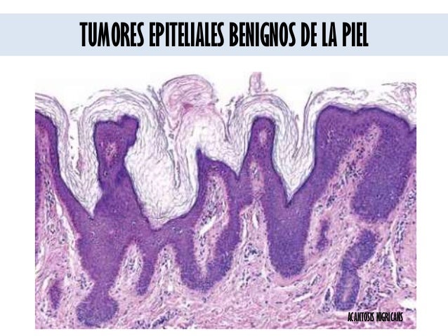 TUMORES DE LA PIEL TUMORES DE LA PIEL