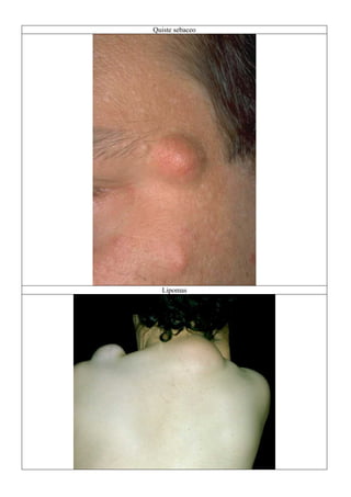 Quiste sebaceo
Lipomas
 