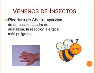 VENENOS DE INSECTOS
 Picadura   de Abeja.- aparición
 de un posible cuadro de
 anafilaxia, la reacción alérgica
 más peligrosa.
 