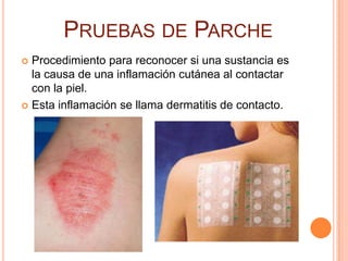 PRUEBAS DE PARCHE
 Procedimiento para reconocer si una sustancia es
  la causa de una inflamación cutánea al contactar
  con la piel.
 Esta inflamación se llama dermatitis de contacto.
 