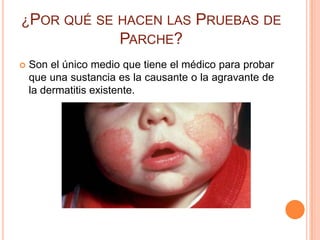 ¿POR QUÉ SE HACEN LAS PRUEBAS DE
                      PARCHE?
   Son el único medio que tiene el médico para probar
    que una sustancia es la causante o la agravante de
    la dermatitis existente.
 