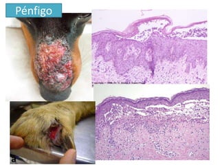 Pénfigo
 