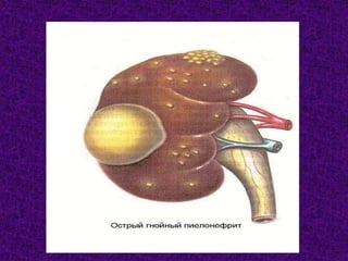 Pielonefrit