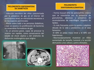 PIELONEFRITIS ENFISEMATOSA
DE DIABÉTICOS
PIELONEFRITIS
XANTOGRANULOMATOSA
- Infección necrótica del riñón caracterizada
por la presencia de gas en el interior del
parénquima renal, en estructuras excretoras o
en los espacios perirrenales
- Afecta sobre todo a las personas diabéticas,
y que se asocia a la proliferación de bacterias
no anaerobias formadoras de gas.
- Es un proceso grave, capaz de provocar la
muerte con rapidez, como consecuencia del
estado de shock séptico y del síndrome de
disfunción multiorgánica que origina
- Forma inusual (6%) de pielonefritis crónica
que se caracteriza por la presencia de
granulomas, abscesos y presencia de
acumulaciones de macrófagos cargados de
lípidos.
- Es más frecuente entre la quinta y séptima
década de la vida y predomina en el sexo
femenino.
-El 60% se palpa masa renal y el 40% son
hipertensos.
- Macroscópicamente muestran un riñón
aumentado de tamaño, tumoral y la sección
demuestra unos cálices y pelvis dilatados.
 