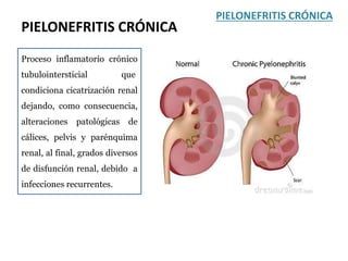 PIELONEFRITIS CRÓNICA
PIELONEFRITIS CRÓNICA
Proceso inflamatorio crónico
tubulointersticial que
condiciona cicatrización renal
dejando, como consecuencia,
alteraciones patológicas de
cálices, pelvis y parénquima
renal, al final, grados diversos
de disfunción renal, debido a
infecciones recurrentes.
 