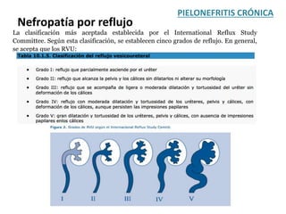 PIELONEFRITIS CRÓNICA
La clasificación más aceptada establecida por el International Reflux Study
Committee. Según esta clasificación, se establecen cinco grados de reflujo. En general,
se acepta que los RVU:
Nefropatía por reflujo
 