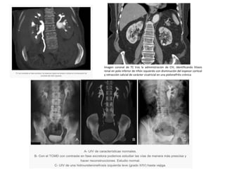 Imagen coronal de TC tras la administración de CIV, identificando litiasis
renal en polo inferior de riñón izquierdo con disminución del espesor cortical
y retracción calicial de carácter cicatricial en una pielonefritis crónica
 