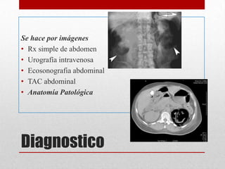 Diagnostico
Se hace por imágenes
• Rx simple de abdomen
• Urografía intravenosa
• Ecosonografia abdominal
• TAC abdominal
• Anatomía Patológica
 
