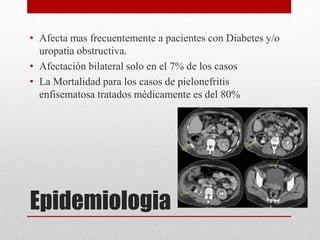 Epidemiologia
• Afecta mas frecuentemente a pacientes con Diabetes y/o
uropatia obstructiva.
• Afectación bilateral solo en el 7% de los casos
• La Mortalidad para los casos de pielonefritis
enfisematosa tratados médicamente es del 80%
 