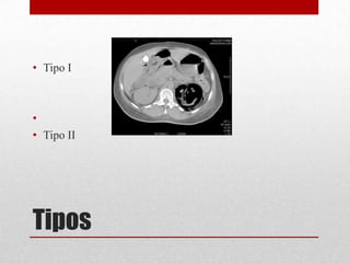 Tipos
• Tipo I
•
• Tipo II
 