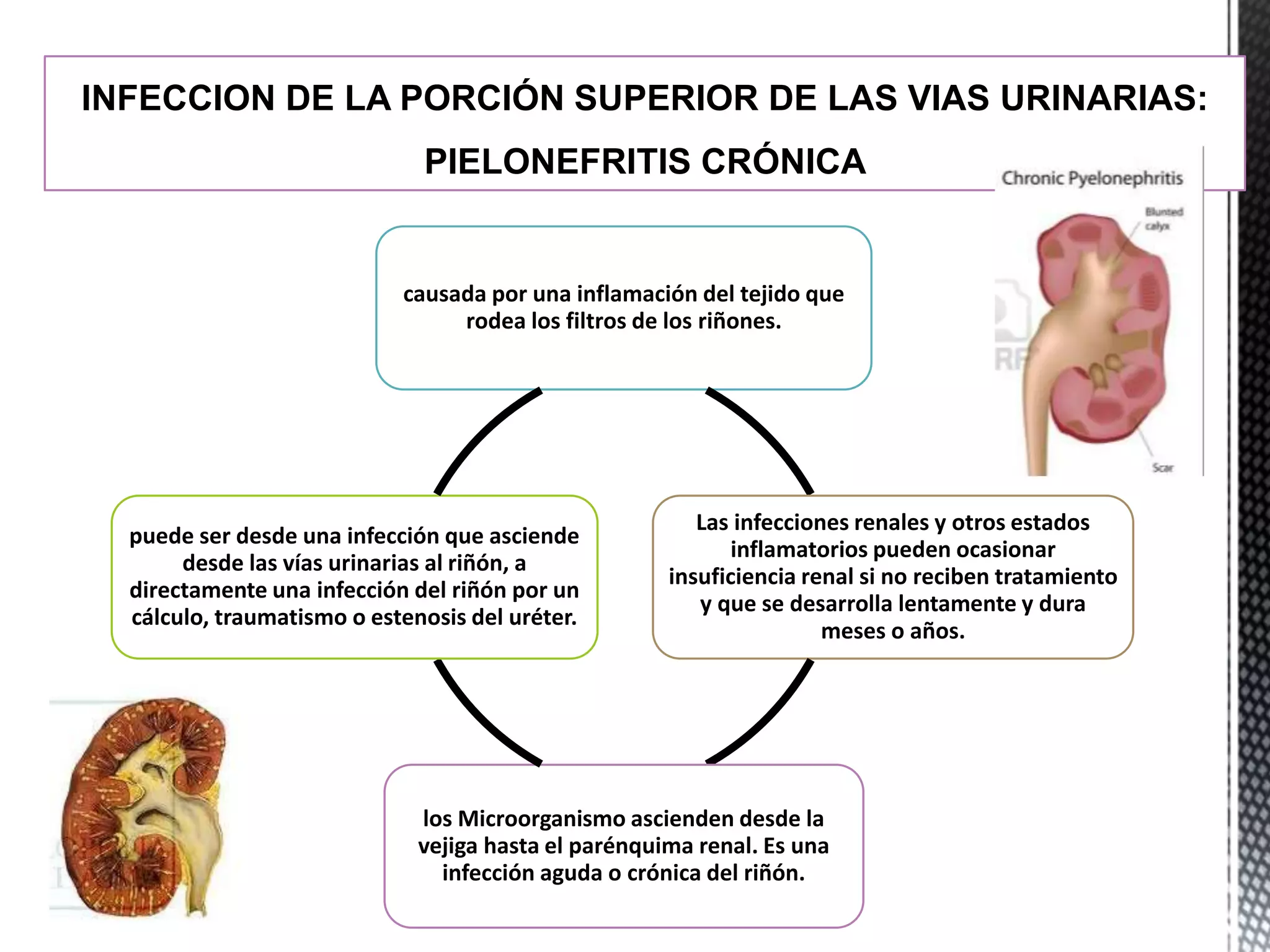 INFECCION DE LA PORCIÓN SUPERIOR DE LAS VIAS URINARIAS:
PIELONEFRITIS CRÓNICA
causada por una inflamación del tejido que
rodea los filtros de los riñones.
Las infecciones renales y otros estados
inflamatorios pueden ocasionar
insuficiencia renal si no reciben tratamiento
y que se desarrolla lentamente y dura
meses o años.
los Microorganismo ascienden desde la
vejiga hasta el parénquima renal. Es una
infección aguda o crónica del riñón.
puede ser desde una infección que asciende
desde las vías urinarias al riñón, a
directamente una infección del riñón por un
cálculo, traumatismo o estenosis del uréter.
 