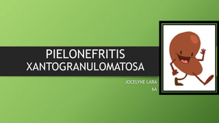 PIELONEFRITIS
XANTOGRANULOMATOSA
JOCELYNE LARA
6A
 