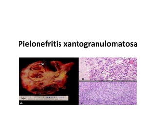Pielonefritis xantogranulomatosa
 