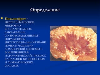 Определение
Определение
 Пиелонефрит
Пиелонефрит –
–
НЕСПЕЦИФИЧЕСКОЕ
МИКРОБНО -
ВОСПАЛИТЕЛЬНОЕ
ЗАБОЛЕВАНИЕ,
СОПРОВОЖДАЮЩЕЕСЯ
ПОРАЖЕНИЕМ
ИНТЕРСТИЦИАЛЬНОЙ ТКАНИ
ПОЧЕК И ЧАШЕЧНО-
ЛОХАНОЧНОЙ СИСТЕМЫ С
ВОВЛЕЧЕНИЕМ В
ПАТОЛОГИЧЕСКИЙ ПРОЦЕСС
КАНАЛЬЦЕВ, КРОВЕНОСНЫХ
И ЛИМФАТИЧЕСКИХ
СОСУДОВ.
 