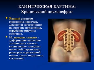 КЛИНИЧЕСКАЯ КАРТИНА:
КЛИНИЧЕСКАЯ КАРТИНА:
Хронический пиелонефрит
Хронический пиелонефрит
 Р
Ранний
анний симптом -
симптом -
гипотония чашечек,
гипотония чашечек,
лоханок и мочеточника
лоханок и мочеточника
на стороне поражения,
на стороне поражения,
огрубение рисунка
огрубение рисунка
сосочков.
сосочков.
 На
На поздних стадиях
поздних стадиях -
-
деформация чашечно-
деформация чашечно-
лоханочных систем,
лоханочных систем,
уменьшение толщины
уменьшение толщины
почечной паренхимы,
почечной паренхимы,
размеров пораженной
размеров пораженной
почки или ее отдельных
почки или ее отдельных
сегментов.
сегментов.
 