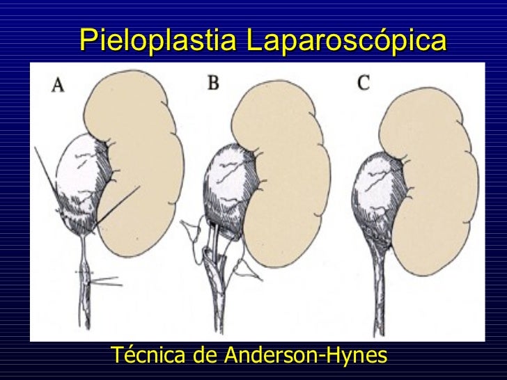 Pieloplastia laparoscópica