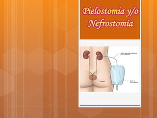 Pielostomia y/o
Nefrostomía
 
