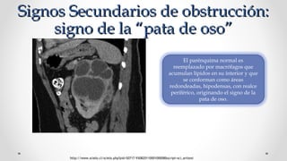 Signos Secundarios de obstrucción:Signos Secundarios de obstrucción:
signo de la “pata de oso”signo de la “pata de oso”
http://www.scielo.cl/scielo.php?pid=S0717-93082011000100008&script=sci_arttext
El parénquima normal es
reemplazado por macrófagos que
acumulan lípidos en su interior y que
se conforman como áreas
redondeadas, hipodensas, con realce
periférico, originando el signo de la
pata de oso.
 