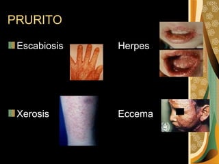 PRURITO Escabiosis Herpes  Xerosis  Eccema  