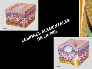 LESIONES ELEMENTALES DE LA PIEL 