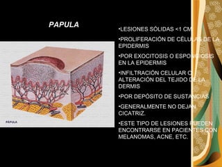 LESIONES SÓLIDAS <1 CM. PROLIFERACIÓN DE CÉLULAS DE LA EPIDERMIS  POR EXOCITOSIS O ESPONGIOSIS EN LA EPIDERMIS  INFILTRACIÓN CELULAR O ALTERACIÓN DEL TEJIDO DE LA DERMIS  POR DEPÓSITO DE SUSTANCIAS  GENERALMENTE NO DEJAN CICATRIZ.  ESTE TIPO DE LESIONES PUEDEN ENCONTRARSE EN PACIENTES CON MELANOMAS, ACNE, ETC.  PAPULA 