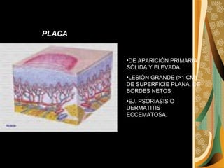 DE APARICIÓN PRIMARIA SÓLIDA Y ELEVADA.  LESIÓN GRANDE (>1 CM), DE SUPERFICIE PLANA, DE BORDES NETOS  EJ. PSORIASIS O DERMATITIS ECCEMATOSA. PLACA 