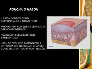 RONCHA O HABON LESIÓN SOBREELEVADA, SUPERFICIALES Y TRANSITORIA. PROVOCADA POR EDEMA DÉRMICO O DERMOHIPODÉRMICO. SU COLOR SUELE SER ROJO-ERITEMATOSO. SON DE PEQUEÑO TAMAÑO EN LA URTICARIA COLINÉRGICA O GRANDES COMO EN LA URTICARIA POR PRESIÓN. 