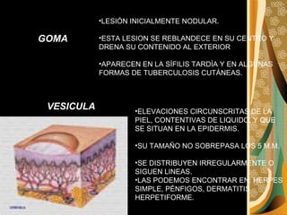 GOMA LESIÓN INICIALMENTE NODULAR. ESTA LESION SE REBLANDECE EN SU CENTRO Y DRENA SU CONTENIDO AL EXTERIOR APARECEN EN LA SÍFILIS TARDÍA Y EN ALGUNAS FORMAS DE TUBERCULOSIS CUTÁNEAS.  VESICULA ELEVACIONES CIRCUNSCRITAS DE LA PIEL, CONTENTIVAS DE LIQUIDO, Y QUE SE SITUAN EN LA EPIDERMIS.  SU TAMAÑO NO SOBREPASA LOS 5 M.M. SE DISTRIBUYEN IRREGULARMENTE O SIGUEN LINEAS.  LAS PODEMOS ENCONTRAR EN: HERPES SIMPLE, PÉNFIGOS, DERMATITIS HERPETIFORME.  