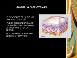 ELEVACIONES DE LA PIEL DE CONTENIDO LIQUIDO  PUEDE SER SUPERFICIALES LOCALIZÁNDOSE DENTRO DE LA EPIDERMIS O  EN LA DERMIS.  EL CONTENIDO PUEDE SER SEROSO O HEMÁTICO. AMPOLLA O FLICTENAS 