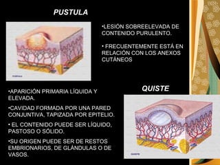 PUSTULA LESIÓN SOBREELEVADA DE CONTENIDO PURULENTO. FRECUENTEMENTE ESTÁ EN RELACIÓN CON LOS ANEXOS CUTÁNEOS QUISTE APARICIÓN PRIMARIA LÍQUIDA Y ELEVADA. CAVIDAD FORMADA POR UNA PARED CONJUNTIVA, TAPIZADA POR EPITELIO. EL CONTENIDO PUEDE SER LÍQUIDO, PASTOSO O SÓLIDO.  SU ORIGEN PUEDE SER DE RESTOS EMBRIONARIOS, DE GLÁNDULAS O DE VASOS.  