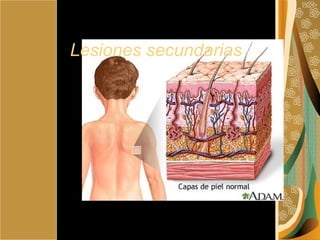 Lesiones secundarias   