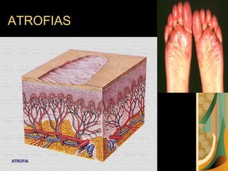 ATROFIAS 