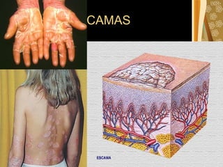 ESCAMAS 