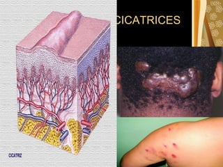 CICATRICES 