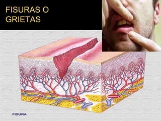FISURAS O GRIETAS 