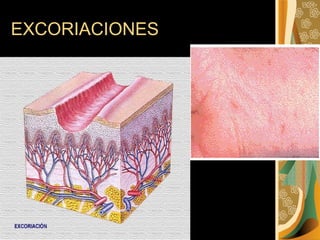 EXCORIACIONES 