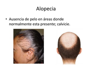 Alopecia 
• Ausencia de pelo en áreas donde 
normalmente esta presente; calvicie. 
 