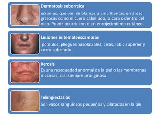 Dermatosis seborreica 
escamas, que van de blancas a amarillentas, en áreas 
grasosas como el cuero cabelludo, la cara o dentro del 
oído. Puede ocurrir con o sin enrojecimiento cutáneo. 
Lesiones eritematoescamosas 
pómulos, pliegues nasolabiales, cejas, labio superior y 
cuero cabelludo 
Xerosis 
Es una resequedad anormal de la piel o las membranas 
mucosas, casi siempre pruriginosa 
Telangiectasias 
Son vasos sanguíneos pequeños y dilatados en la pie 
 